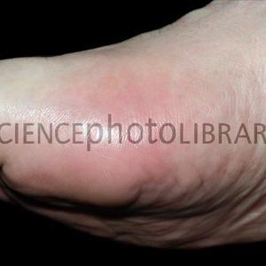 Natural Remedy For Gout - Factors As Well As Cures Of Gout