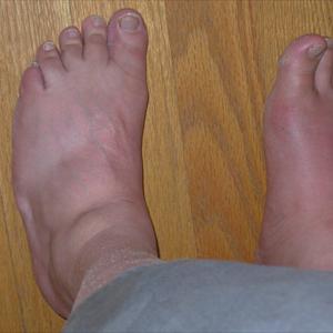 Acupuncture To Cure Gout - How To Get Respite From Common Base Problems Bunions, Corns And More