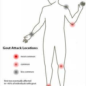 Dissolving Uric Acid - Gout Diet Plan Recommendations That Work