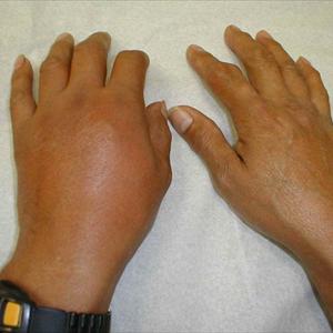 Stop Gout Pain - Gout: New Treatments And Recommendations For Prevention