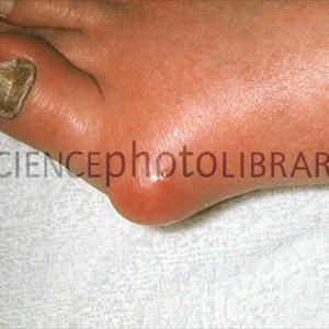 Does The Gout Remedy Report Work - Notice Allopurinol Adverse Reactions