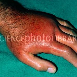 How Long Gout Attacks Last - Gout Causes And Symptoms And Foods To Avoid And Treatment To Get Rid Of Gout