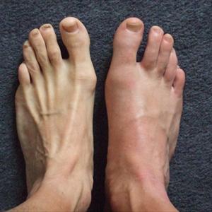 Topical Cream For Gout Toe - Remedies For Gout You Should Know