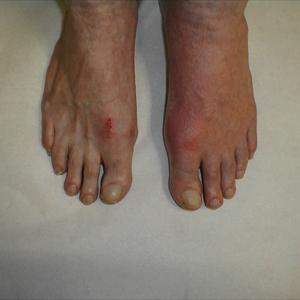 Problems With Foot After Gout Surgery - Can Magnet Therapy Relieve Gout Pain?