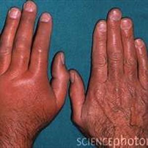 How To Heal Gout Arthritis - Homeopathic Treatment Of Gout