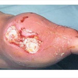 Does Allopurinol Affect Liver And Kidney Function - Guidelines On How To Cure Gout Warning Signs