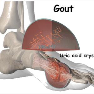 Natural Treatment For Gout - Proven Impressive Remedies Just For Gout