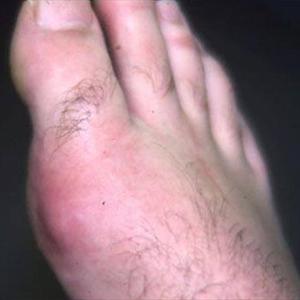 Uric Acid High Left Big Toe Throbbing - Gout Toe Treatment - Neutralizing Uric Acid Will Cure Gout