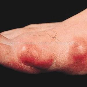 Mulberry Leaves And Gout - Using Gout Remedies