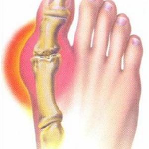 Vitamins Uric Acid - Alcohol And Gout